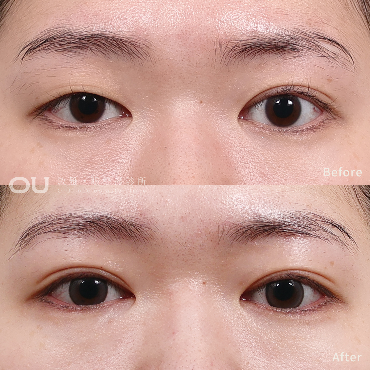 右眼縫式雙眼皮 • 右眼抽脂