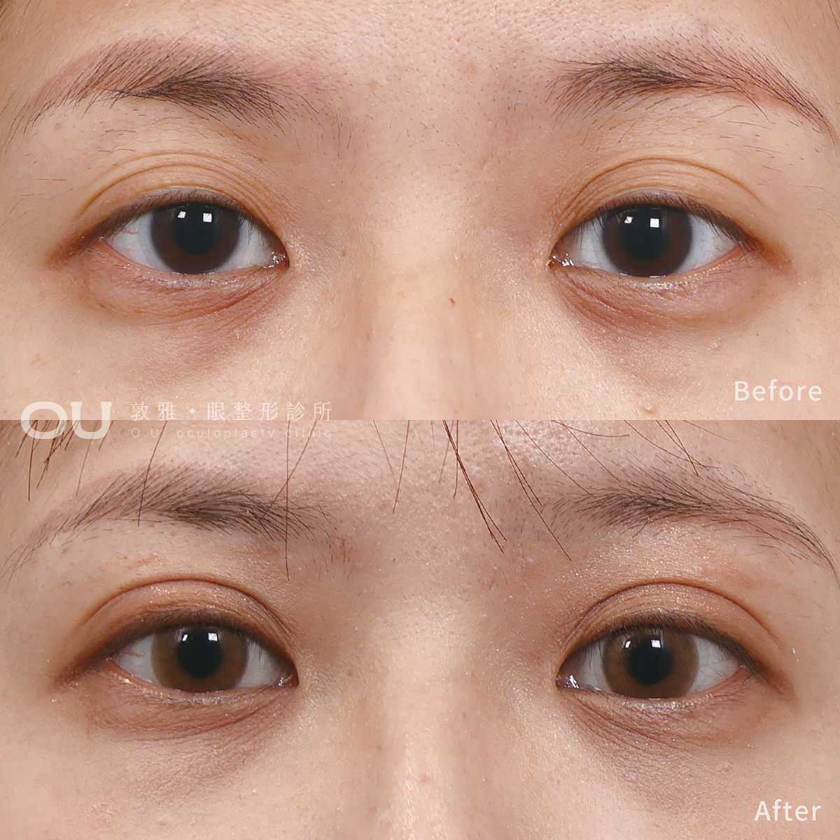 重修右眼縫式雙眼皮 • 雙眼提眼肌