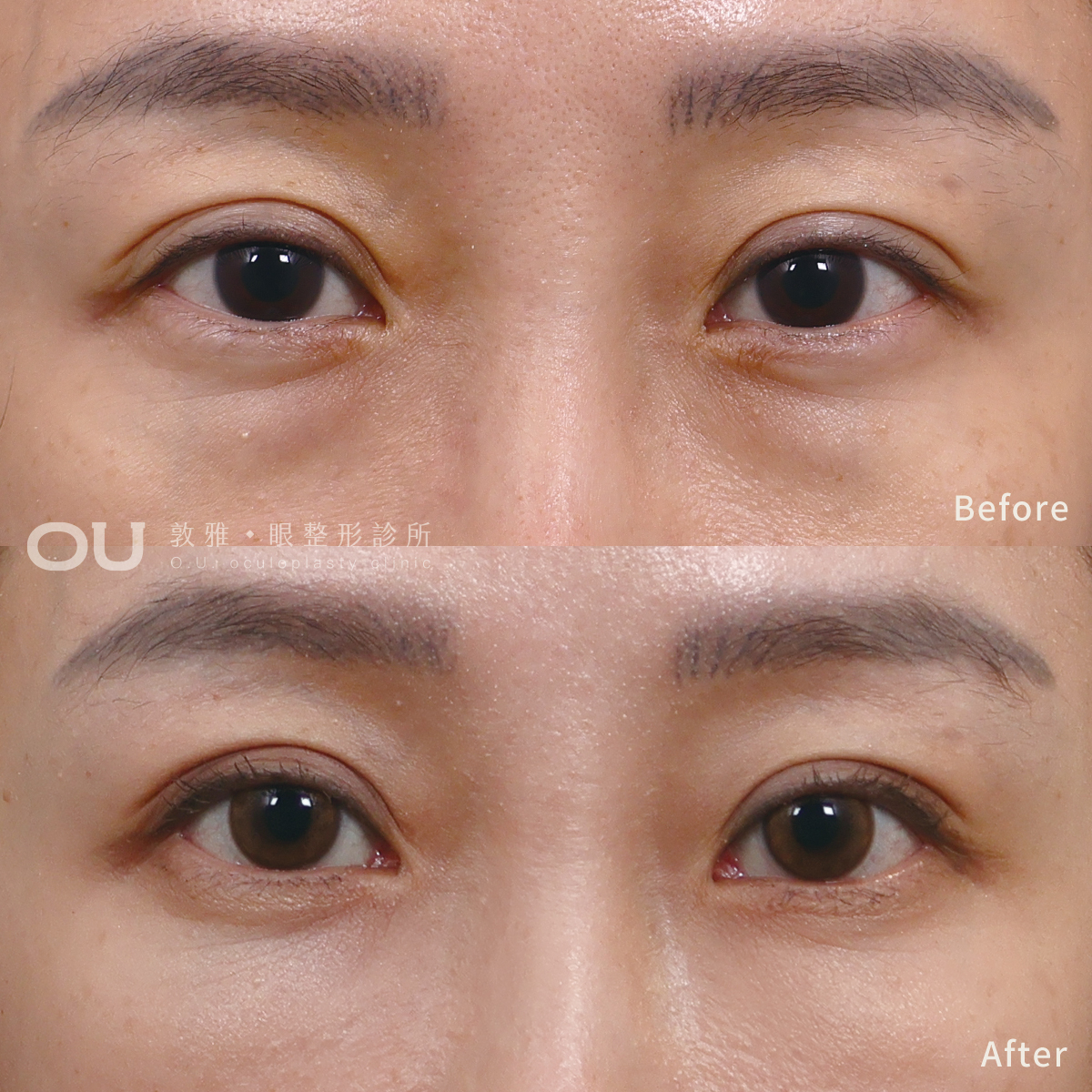 眼袋內開 • 抽脂補脂