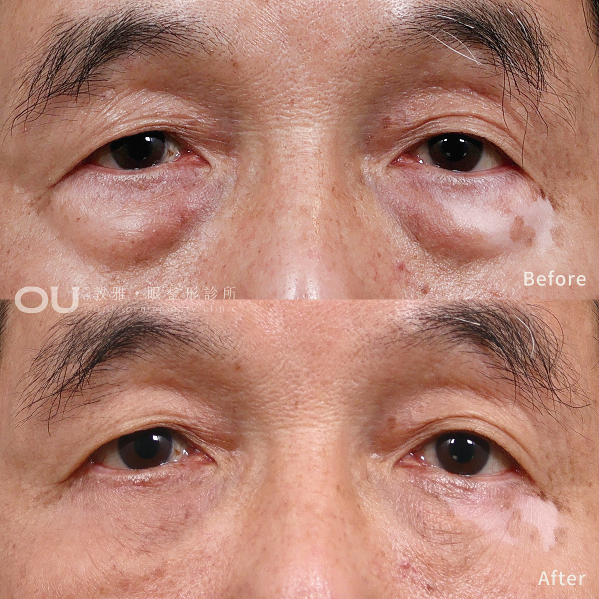 眼袋內開 • 修皮 • 抽脂補脂